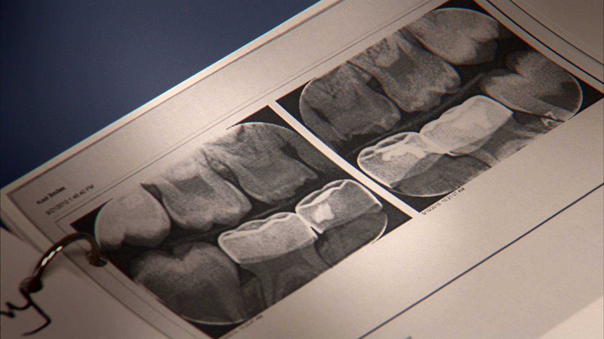 xrays