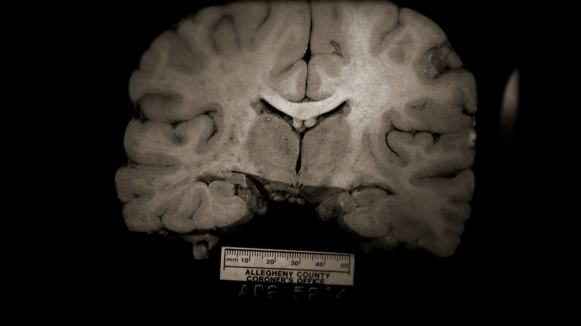 brain