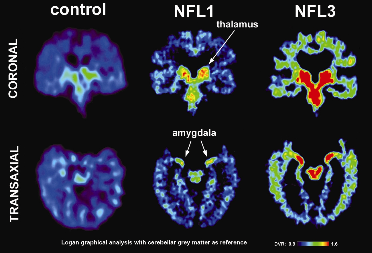 CTE scan in living players