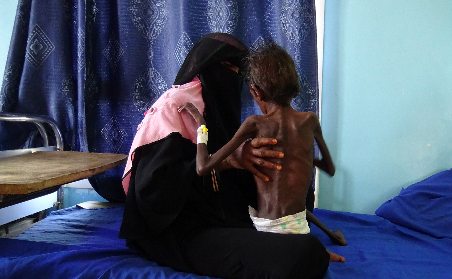 YEMEN-CONFLICT-MALNUTRITION